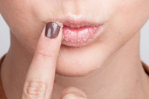 Чому сохнуть і тріскаються губи: три основні причини
