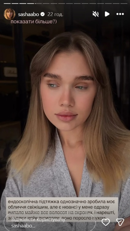 Наслідки підтяжки обличчя: у блогерка Саші Бо випадає волосся
