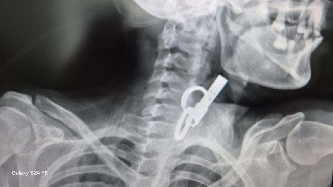 Проковтнула ключ від будинку, бо не хотіла пускати родичів до оселі