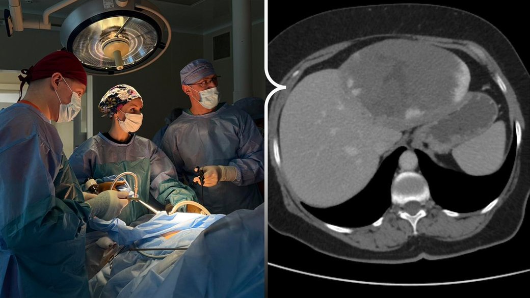 Рівненські хірурги прооперували 15-сантиметрову пухлину печінки у 64-річної пацієнтки