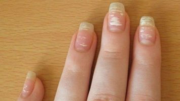Білі плями, жовтизна, задирки: на які проблеми вказують дефекти нігтів