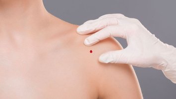 Червоні цятки на тілі: чому вони з`являються і як їх позбутись