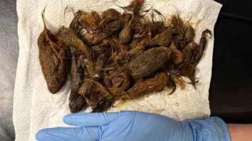 Із шлунка 7-річної дівчинки витягли майже кілограм волосся 