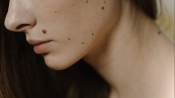 Родимки на обличчі: що приховують