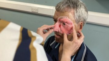 В Британії для чоловіка створили на 3D-принтері обличчя, який приховує наслідки травми