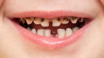 Як зупинити карієс і зберегти здоров’я зубів